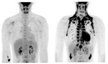 Röntgen opname bruinvet in het lichaam